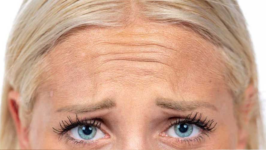 treating wrinkles and forehead lines