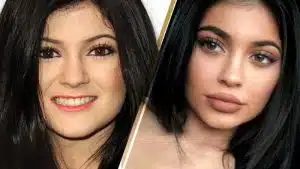 thin-lip-fillers-dermal-fillers